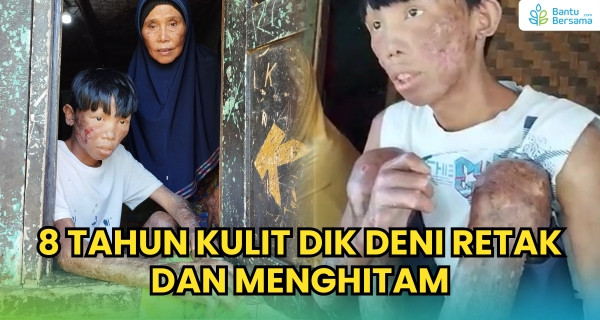 8 Tahun Kulit Dik Deni Retak Dan Menghitam