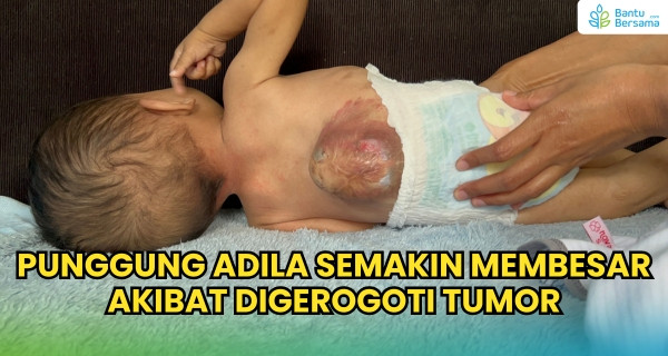 Benjolan Terus Membesar, Bantu Adila Melawan Tumor