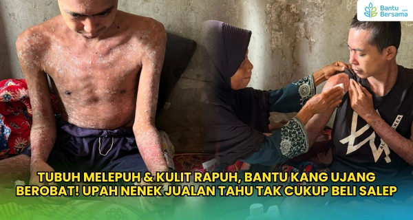 Luka Bernanah Selimuti Tubuh Kang Ujang, Upah Nenek Tak Cukup Beli Salep