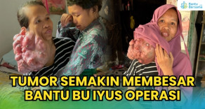 Bu Iyus, Penjual Gorengan Dengan Tumor Besar Di Wajahnya