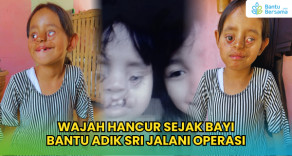 Wajah Hancur Sejak Bayi, Bantu Adik Sri Jalani Operasi